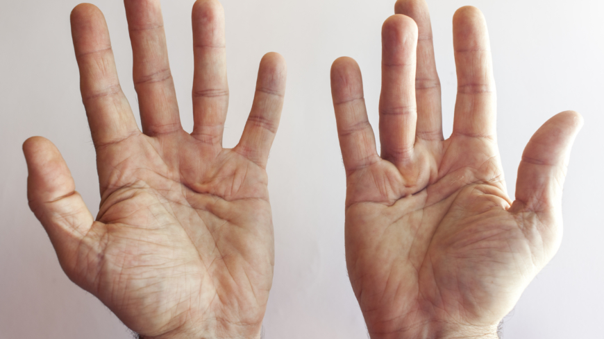  Om ett finger börjar kröka sig kan det vara ett första tecken på sjukdomen Dupuytrens kontraktur. Foto: Shutterstock